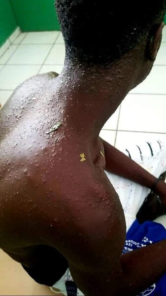 Haïti/Santé :le MSPP publie finalement le résultat de l'analyse du spécimen relatif au cas suspect de variole du singe dans l'Artibonite